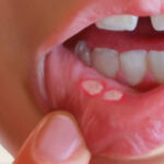 درمان آفت دهان با استفاده از گیاهان دارویی
