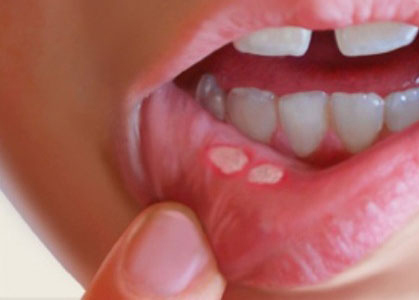 درمان آفت دهان با استفاده از گیاهان دارویی امراض و بیماریها